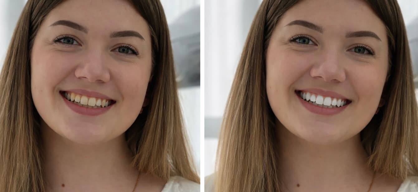 Sbiancamento dentale: mito vs. realtà