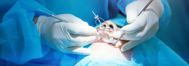 L'impianto dentale: tutto quello che devi sapere