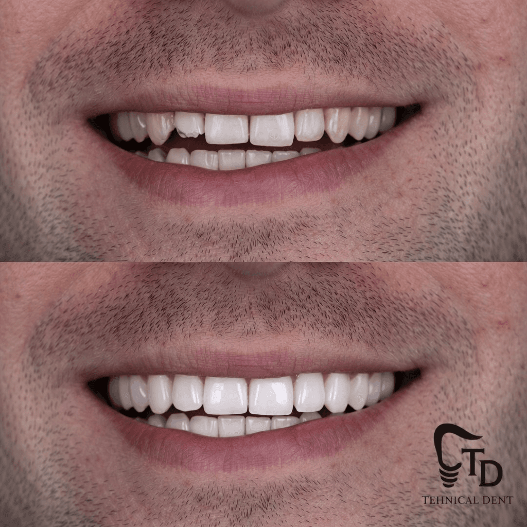 Fațete ceramice : rezultatele noastre