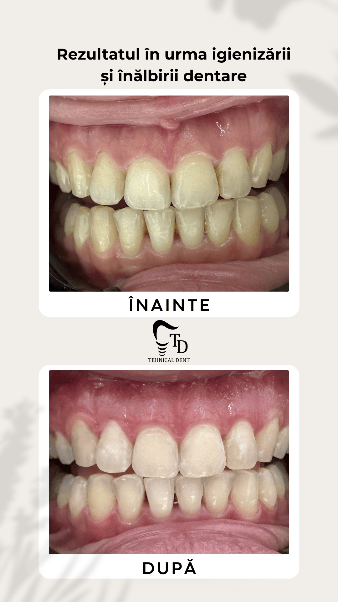 Estetică Dentară — Beneficii