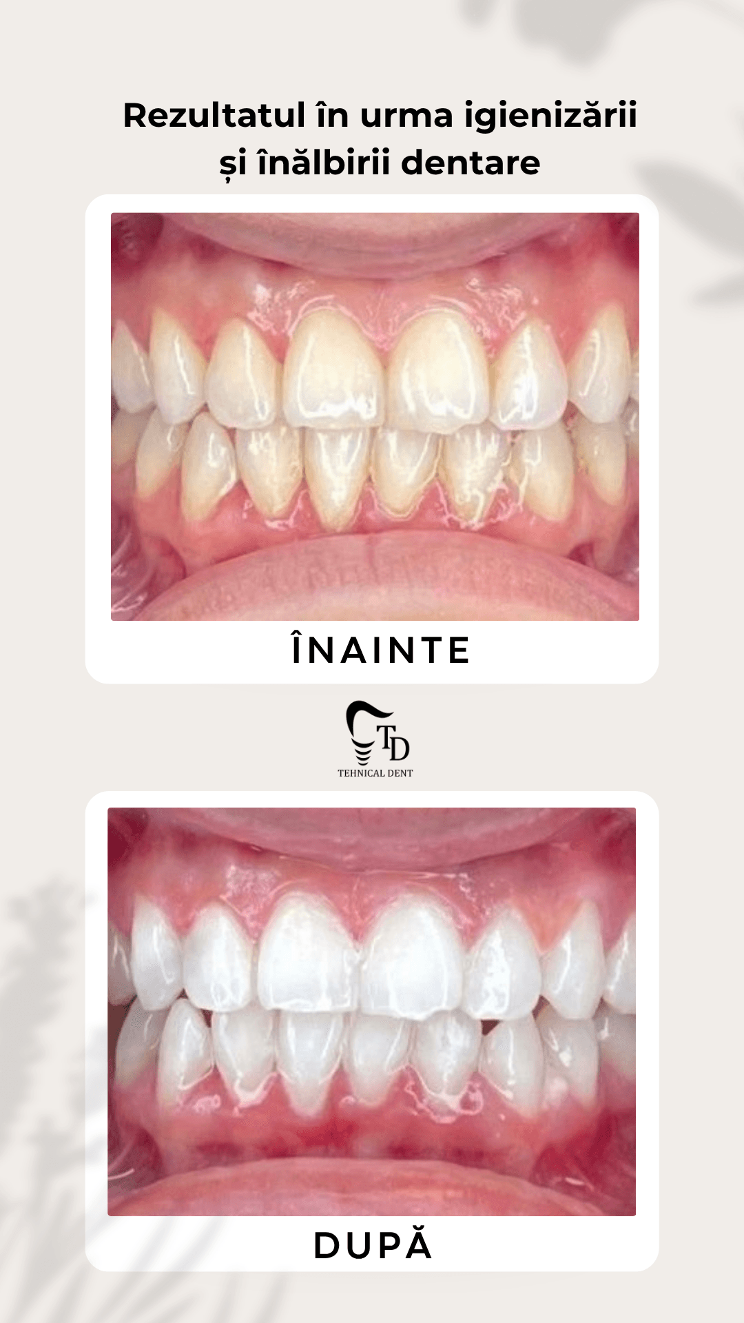 Estetică Dentară — Procesul de tratament