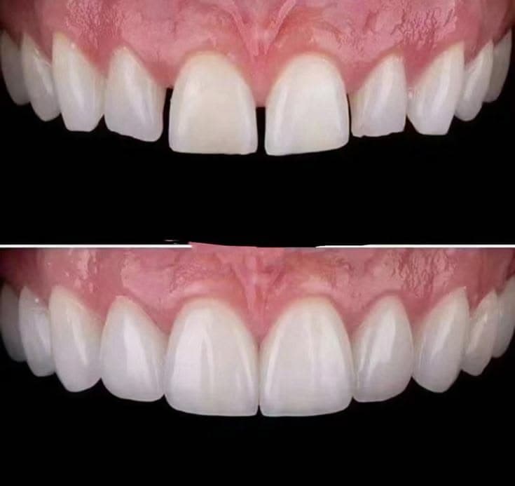 Faccette in ceramica — trasformazione completa