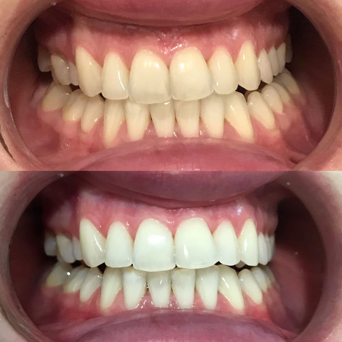 Prima e dopo sbiancamento dentale
