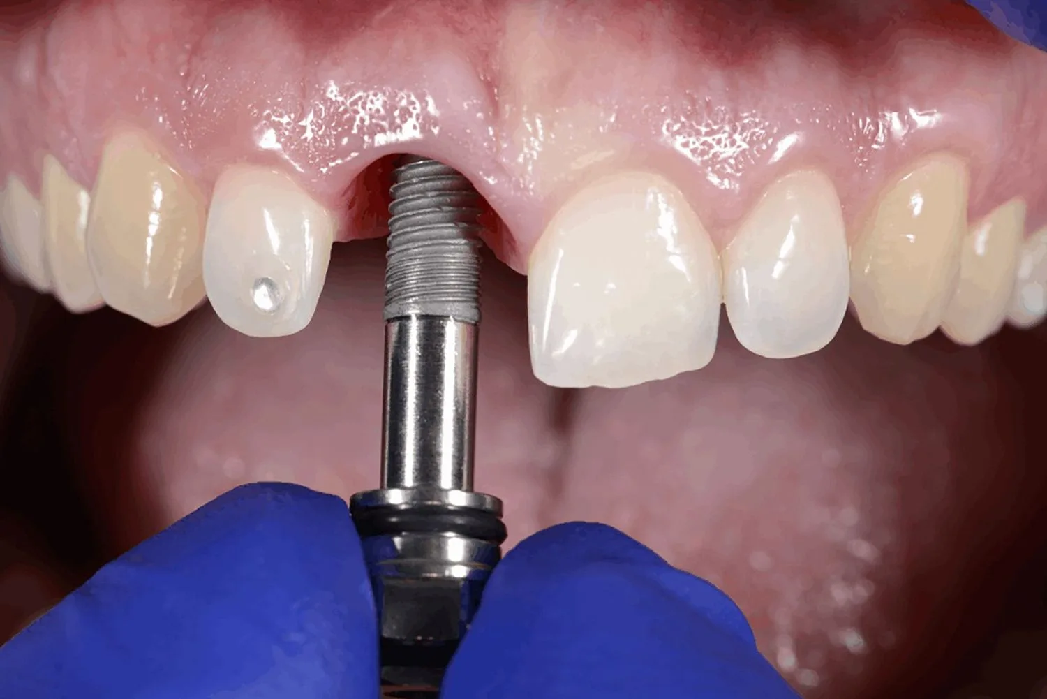 Dental implant result