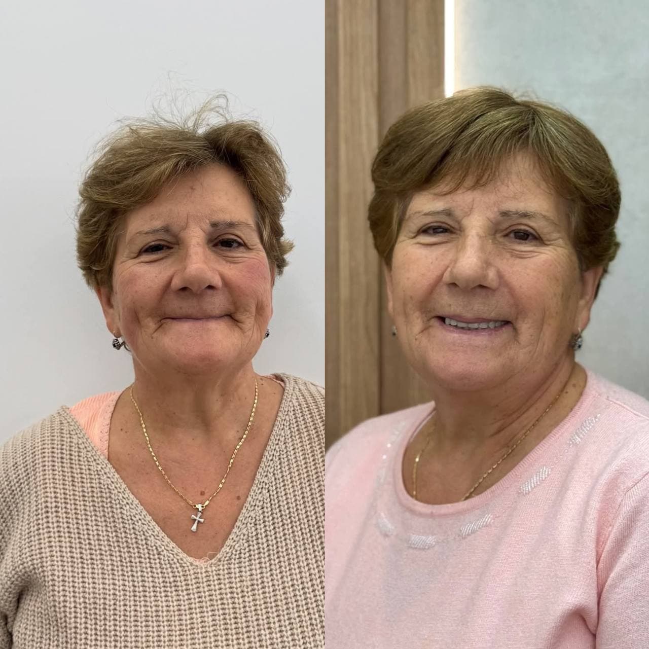 Implant-supported prosthesis — final result