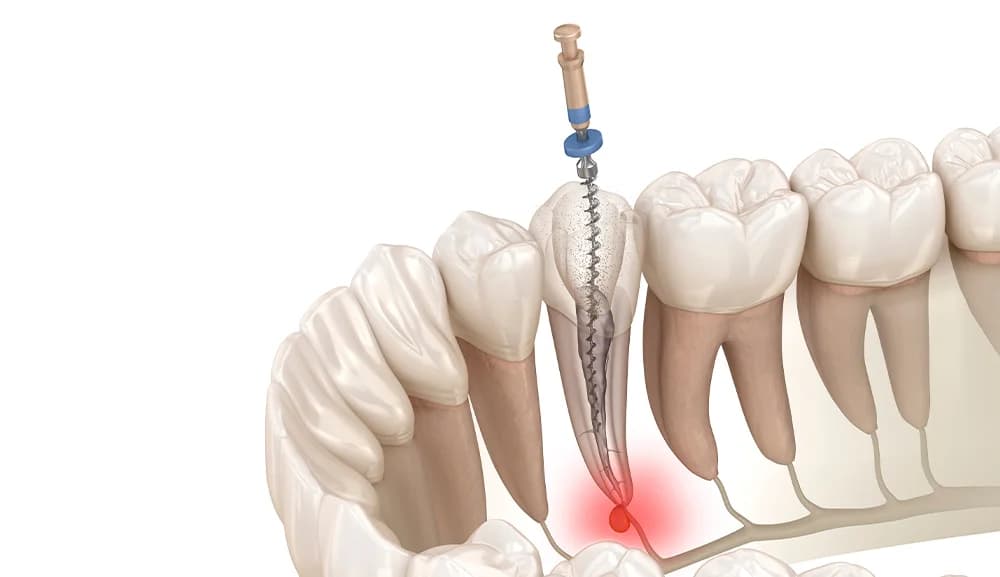 Endodonzia — Panoramica generale